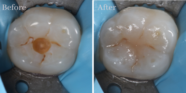 Fillings case 1