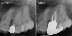 Root Canal Treatment January 29, 2021