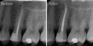 Root Canal Treatment Case 3