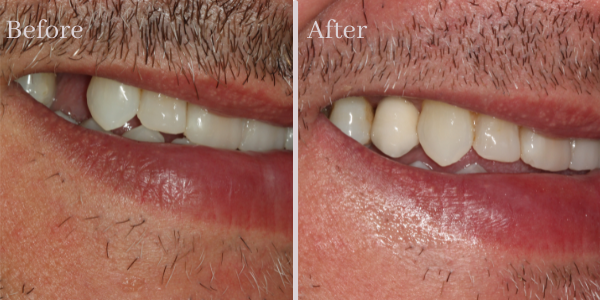 Dental Implants Case 2 Before - After